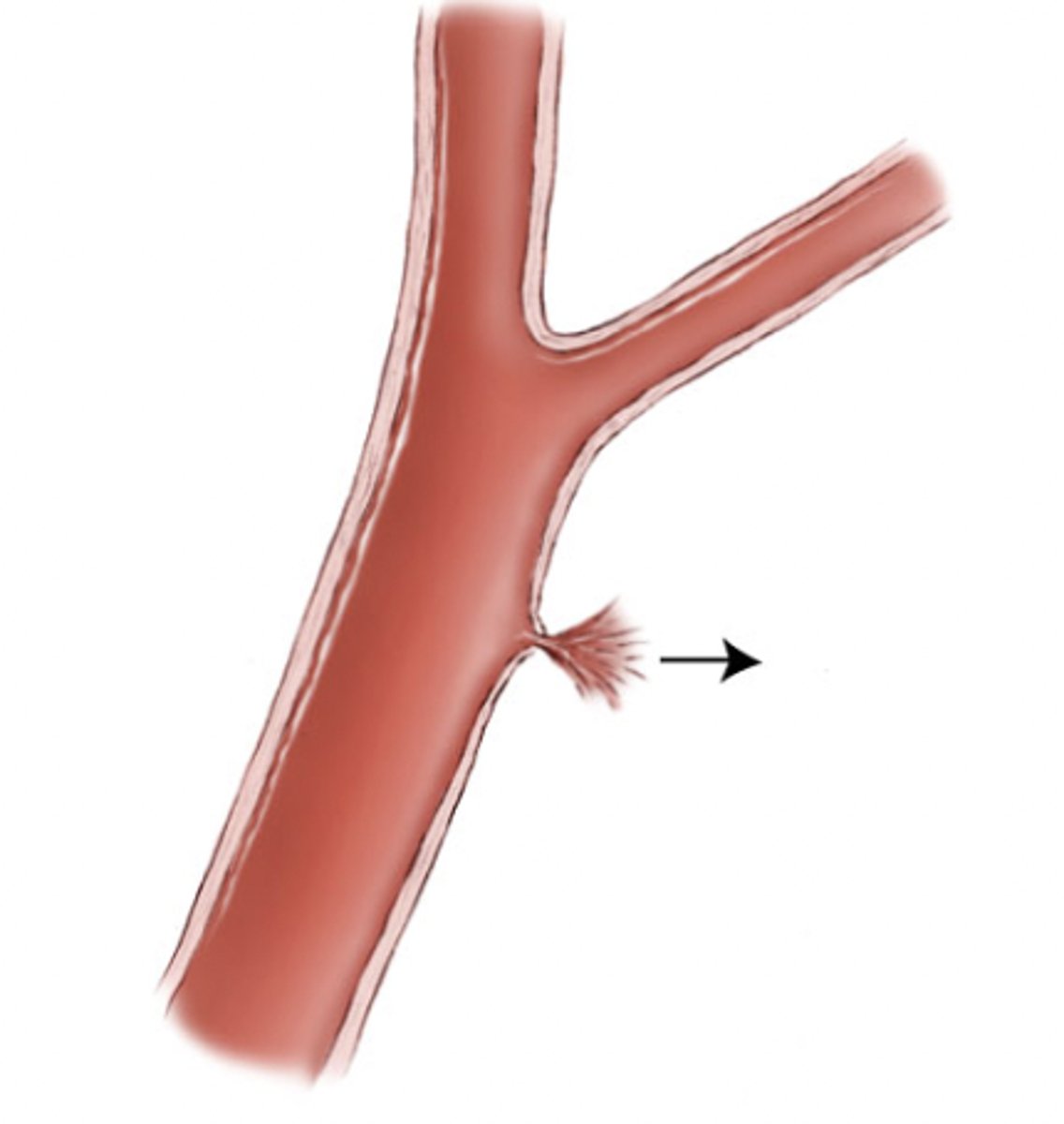 <p>the loss of a large amount of blood in a short time</p>