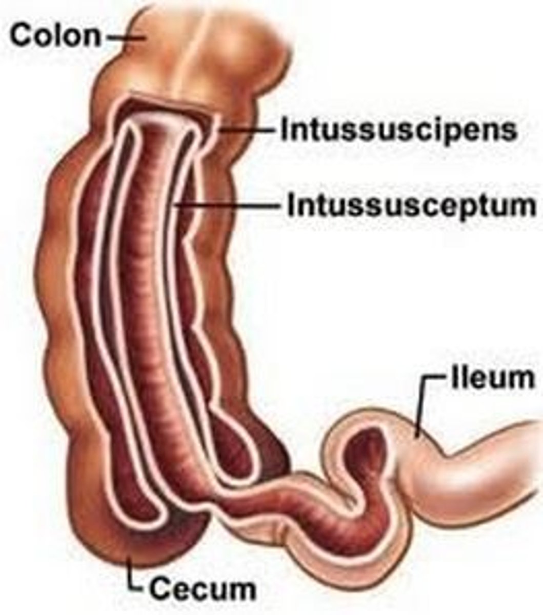 <p>telescoping of a segment of the small intestine into the large intestine, most common cause of intestinal obstruction in toddlers</p>