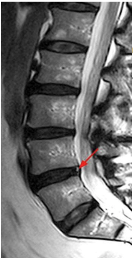 <p>What might the high signal at the posterior aspect of the disc (indicated by red arror) be?</p>