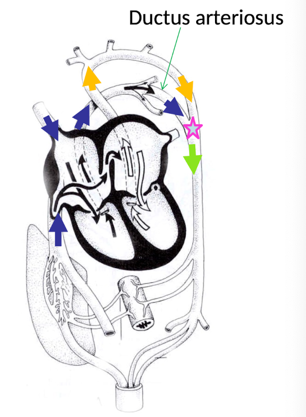 <ul><li><p><strong>Deoxygenated blood</strong> returning from the head and upper body enters the <strong>right atrium via the cranial (superior) vena cava (Blue arrow)</strong> and is directed into the <strong>right ventricle</strong>.</p></li><li><p>Because the fetal lungs are <strong>fluid-filled and not ventilated</strong>, the <strong>pulmonary vascular resistance is very high</strong>, so little blood can flow into the pulmonary arteries.</p></li><li><p>Instead, blood is diverted through the <strong>ductus arteriosus (Star)</strong>, a shunt that connects the <strong>pulmonary artery directly to the aorta</strong>, bypassing the lungs.</p></li><li><p>This shunted blood mixes with the more oxygenated blood in the aorta, resulting in a <strong>lower pO₂ in blood supplied to the lower body</strong> compared with blood going to the brain and heart (Green arrow)</p></li></ul><p></p>