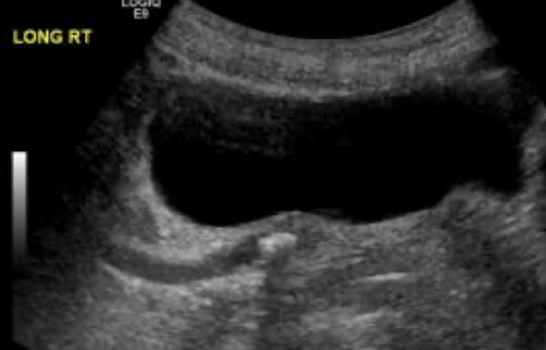 <ul><li><p>short for <mark data-color="yellow" style="background-color: yellow; color: inherit;">ureterovesical junction</mark></p></li><li><p><mark data-color="yellow" style="background-color: yellow; color: inherit;">near bladder</mark></p></li></ul><p></p>