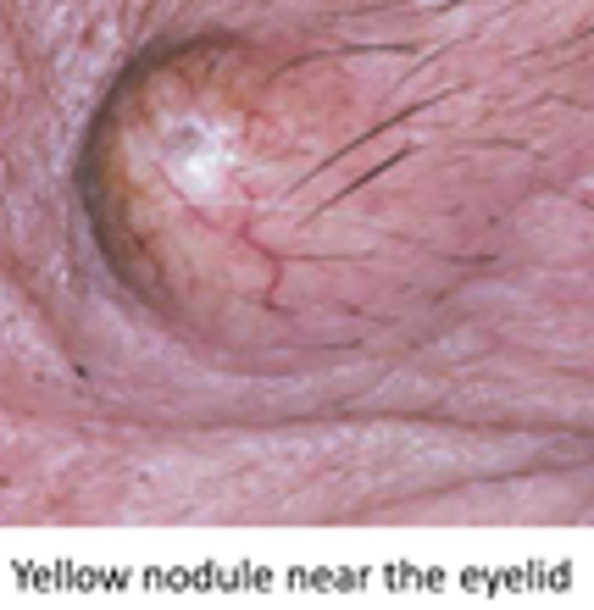<p>• movable fluctuant nodule - raised</p><p>• yellowish - white - or normal skin appearance</p>