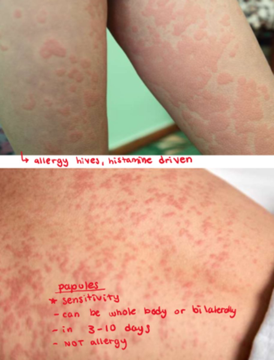 <p>- hives: allergic rxn, d/t overdrive histamine response</p><p>- papules: NOT an allergy, it is a sensitivity (not histamine driven), very common, seen in 3-10 days of abx tx</p>