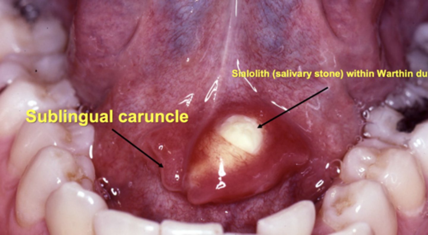 <p>the submandibular gland</p><p>the submandibular gland enters via the whartons duct at the sublingual caruncle </p>