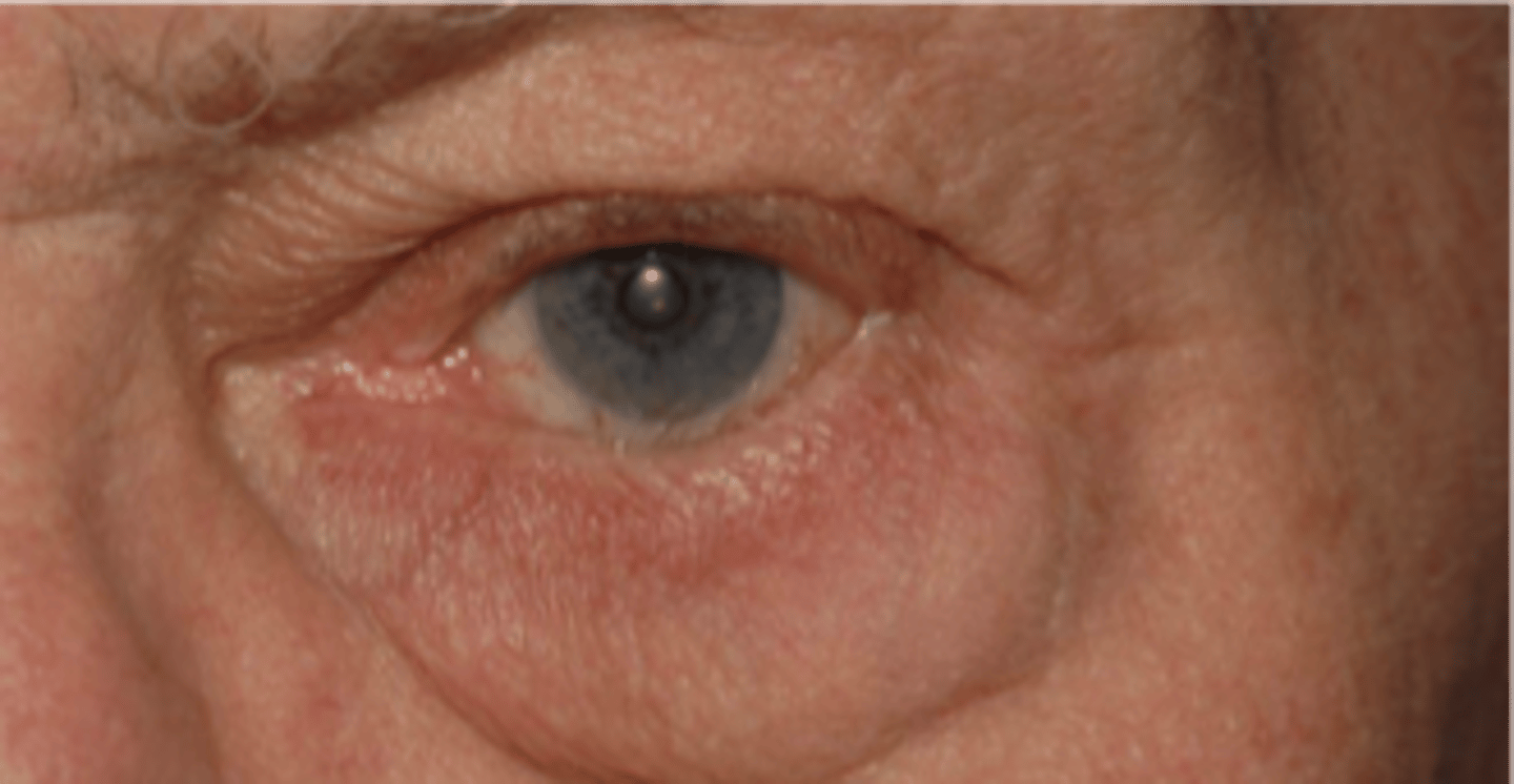 <p>name the eyelid abnormality</p>