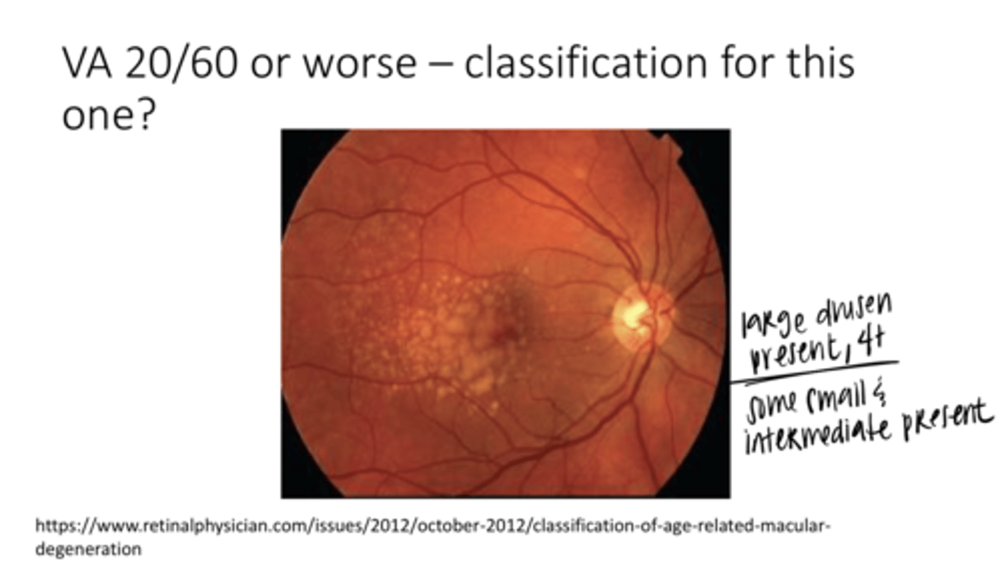 <p>Does this patient need an OCT?</p>