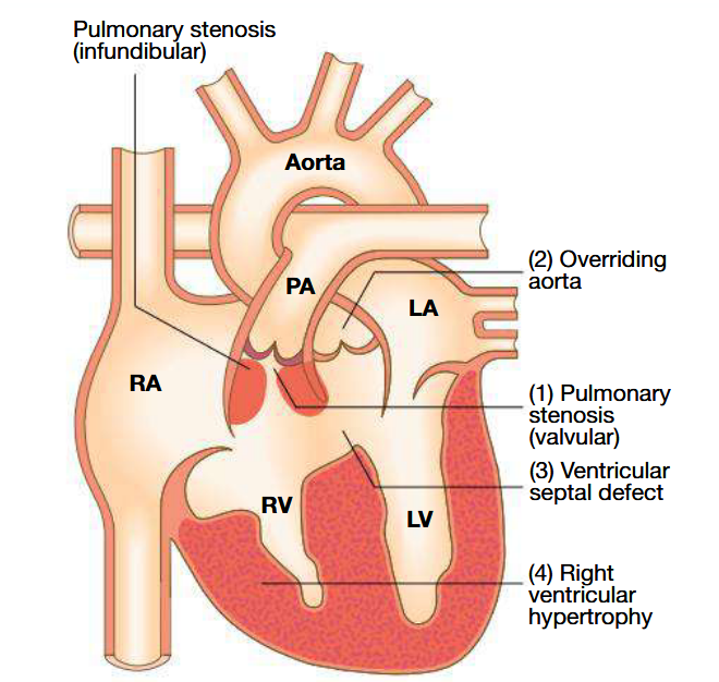 <ul><li><p>RV hypertrophy</p></li><li><p>Larger VSD and overriding aorta</p></li><li><p>Ventricular outflow tract obstruction</p></li></ul><p></p>