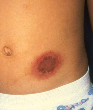 <p>Fixed Drug Eruptions </p>