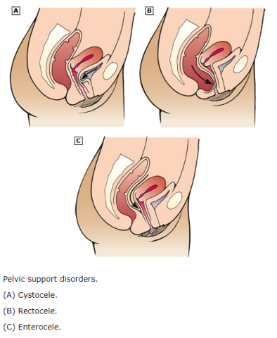 <p><strong>Pelvic Organ Prolapse: Background</strong></p><p>-The __________ of the pelvic organs to or beyond the ________ walls </p><p>-Anterior compartment prolapse (cystocele) → hernia of _________ vaginal wall often associated with descent of the bladder </p><ul><li><p>Letter A on diagram</p></li></ul><p>-Posterior compartment prolapse (rectocele) → hernia of __________ vaginal segment often associated with descent of the ______</p><ul><li><p>Letter B on diagram</p></li></ul><p>-Enterocele → hernia of the _________ to or through the vaginal wall </p><ul><li><p>Letter C on diagram</p></li></ul><p>-Apical compartment prolapse → descent of the ____ of the vagina into the lower vagina, to the hymen, or beyond the vaginal introitus </p><p>-Uterine procidentia → herniation of all three compartments through vaginal introitus </p><p></p>