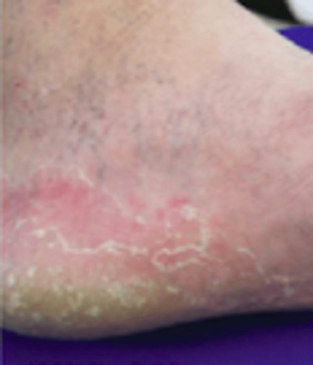 <p>Fungal Skin Infections:</p><p>Type of Tinea Pedis:</p><p>- well-demarcated erythema with OR without papules at the margins, fine white scaling, hyperkeratosis</p>