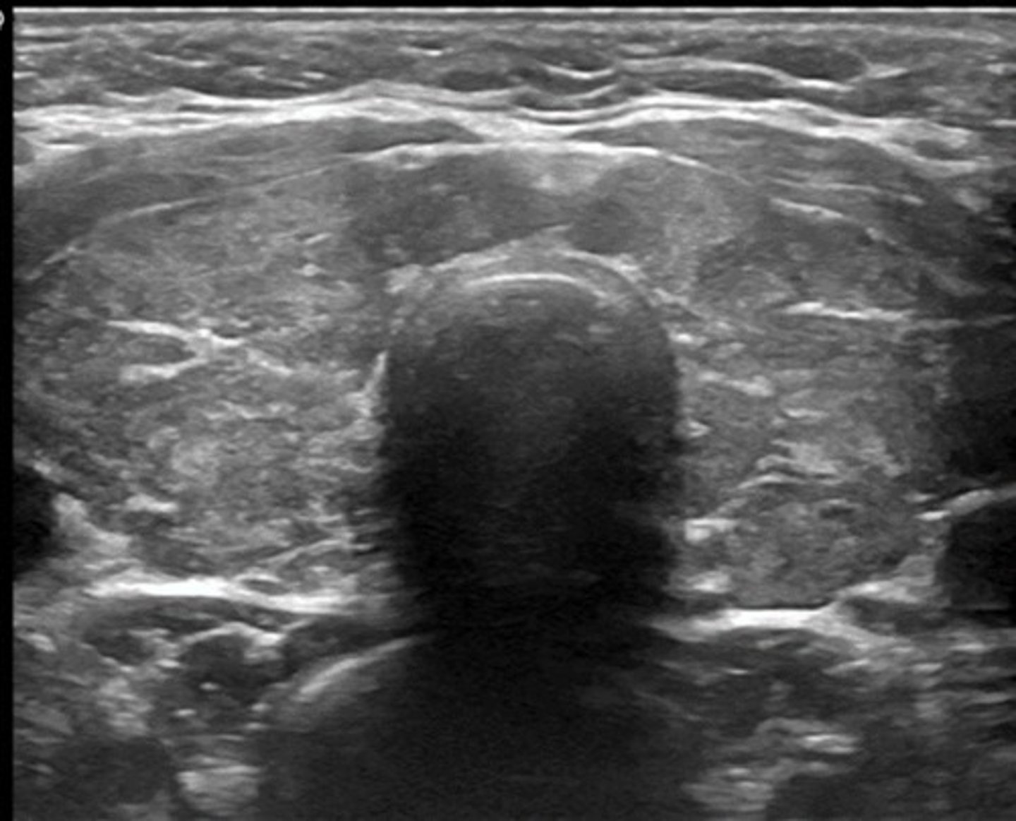 <p>Enlarged thyroid (goiter)</p><p>Bulging eyes</p><p>Thick, red skin on skins/tops of feet</p>