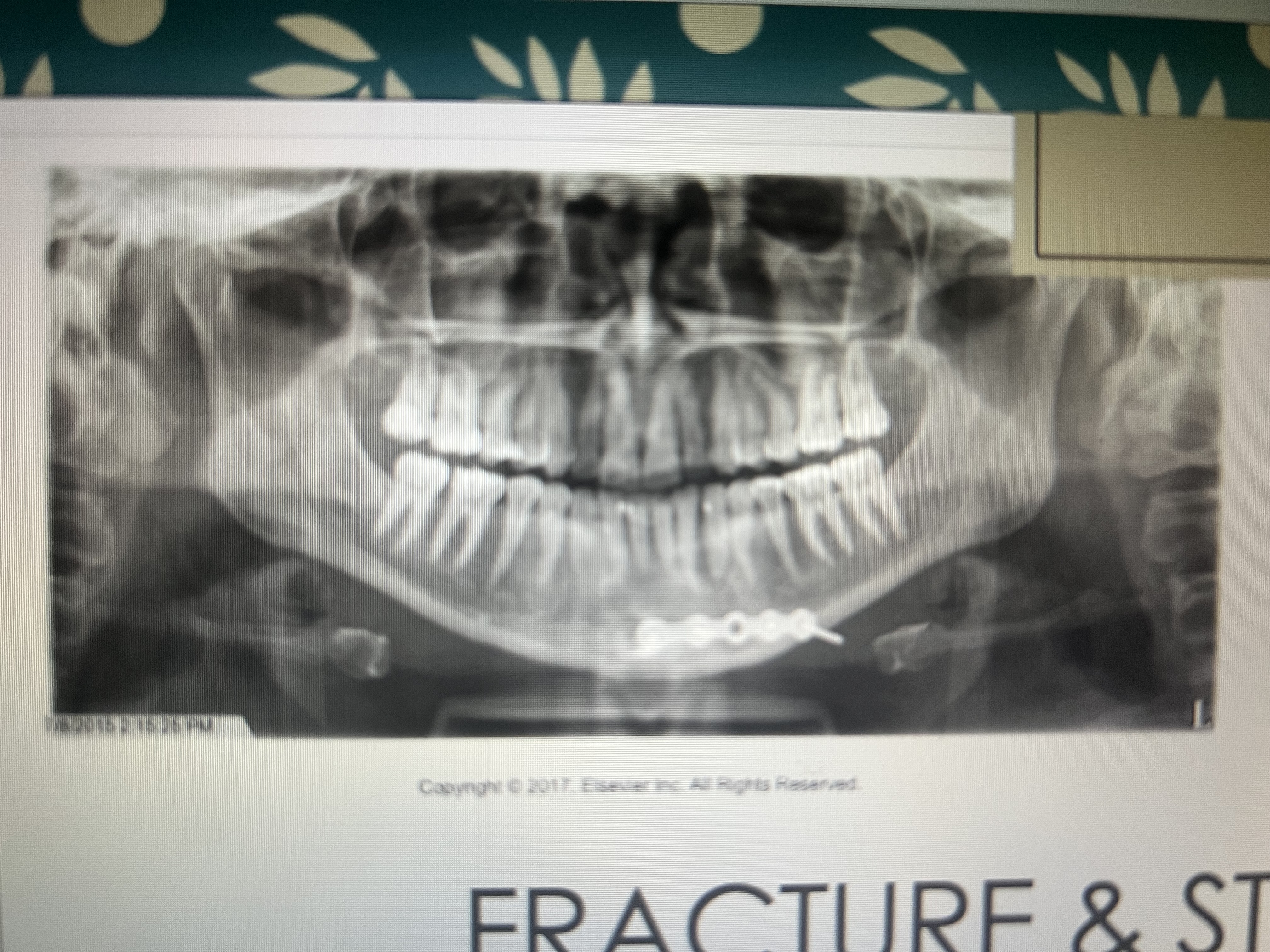 <p>As thin radiopaque lines</p>