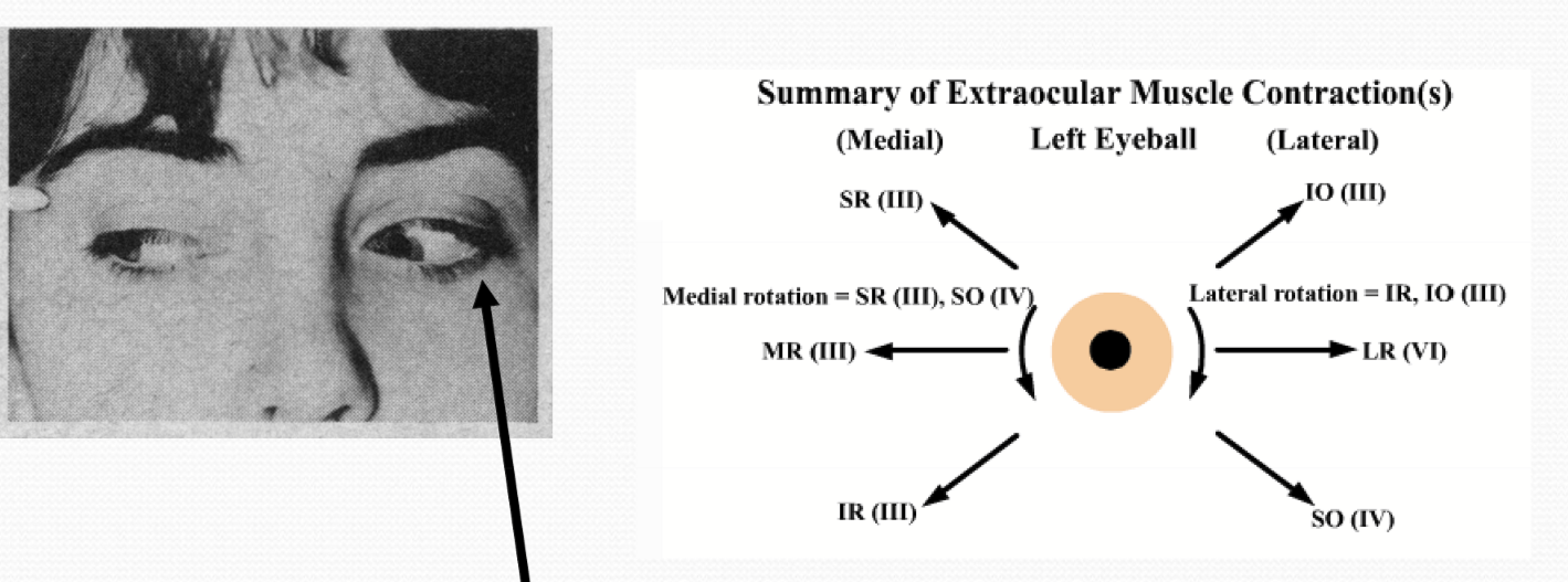 <p>Misdirection of fibers intented for the medial rectus to the levator, causing lid rectraction in downward inward gaze</p>