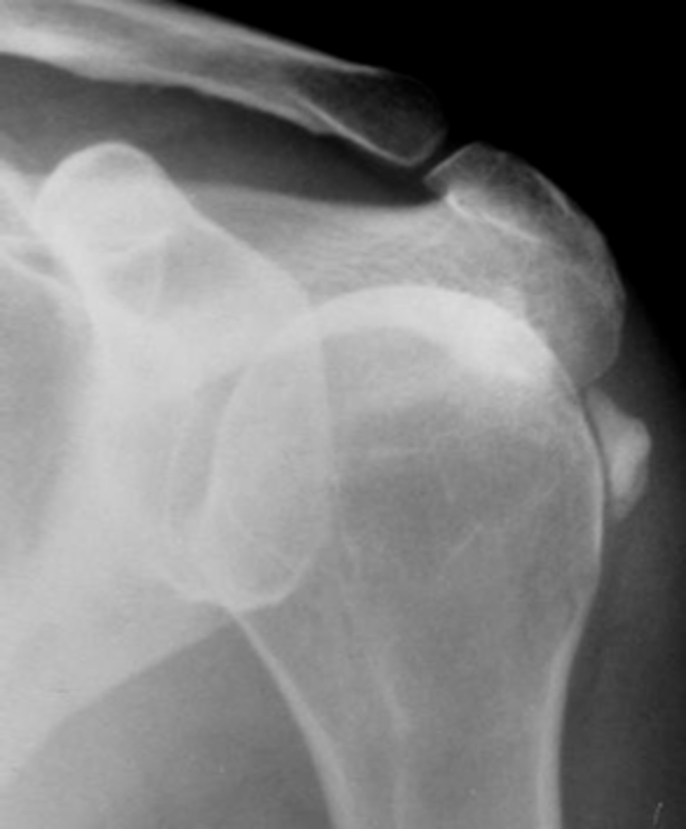 <p>Hydroxyapatite deposition disease (HADD) of the _____</p>