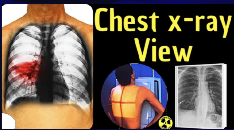 <p>used to diagnose cardiac disease and monitor patient response to drug and nondrug therapy. It is used to determine the size and shape of the atria and ventricles, to calculate the cardiothoracic ratio, and to detect abnormalities in the  lung fields and pleural spaces.</p>