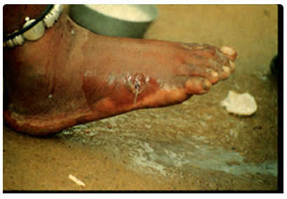 <p>The clinical manifestations are localized but incapacitating. The worm emerges as a ________(duration of emergence: 1 to 3 weeks) in the center of a painful ulcer, accompanied by inflammation and frequently by secondary bacterial infection.</p>