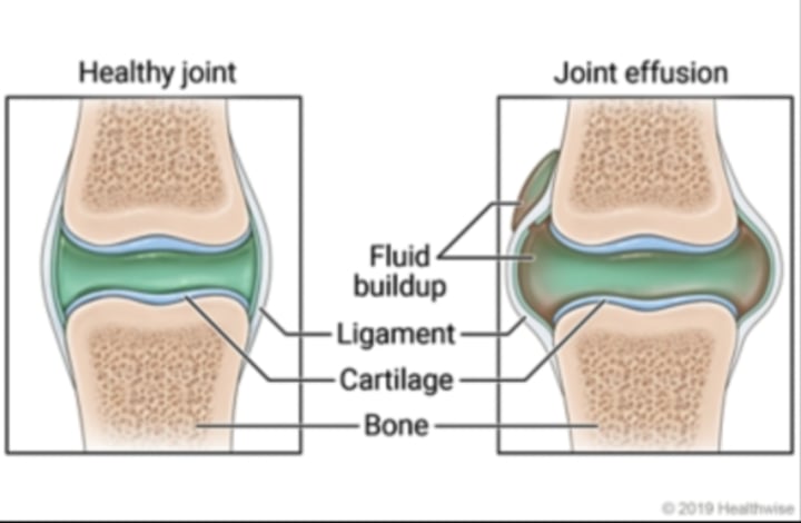 <p>Accumulation of fluid in joint associated with underlying condition</p>