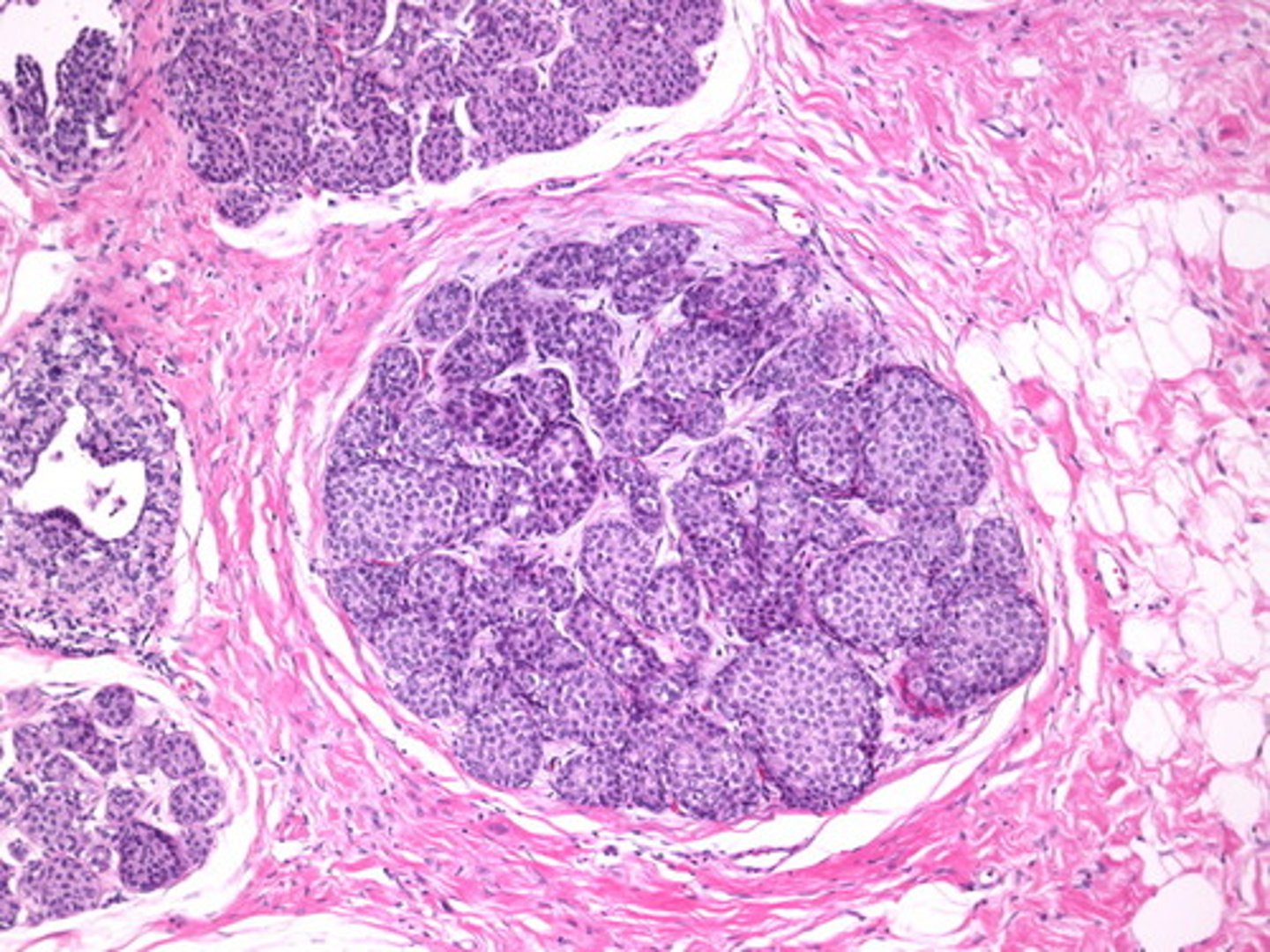 <p>Define Type of Breast Cancer:</p><p>Malignant proliferation of cells in lobules with no invasion of the basement membrane</p><p>-Hx: Discovered INCIDENTALLY on biopsy</p><p>-Path: Dyscohesive cells due to loss of E-cadherin adhesion protein</p><p>-Dx: Does NOT produce a mass or calcifications</p><p>-Prog: Inc risk of carcinoma in EITHER breast</p>