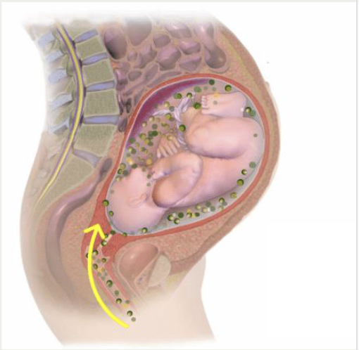 <p>infection of the amniotic fluid, fetal membranes (chorion and amnion), and sometimes the placenta</p><p><strong>Risk factors</strong></p><ul><li><p>long labor</p></li><li><p>prolonged ROM</p></li><li><p>multiple cervical exams</p></li><li><p>internal monitors (FSE, IUPC)</p></li><li><p>Meconium-stained fluid</p></li></ul><p><strong>Maternal risk: </strong>sepsis, dysfunction labor</p><p><strong>Neonatal risk:</strong> infection respiratory distress, death</p><p></p><p></p>