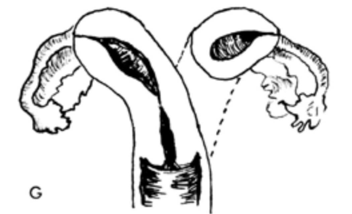 <p>Unicornuate Uterus</p>