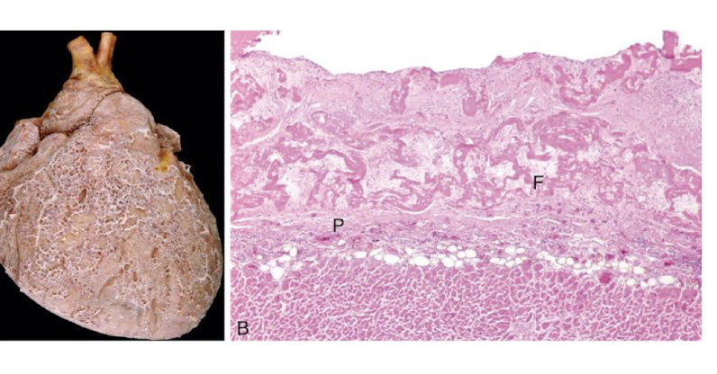 <p>Which morphologic pattern exemplifies:</p><ul><li><p>characteristic of inflammation in the lining of body cavities including the meninges, percardium, and pleura</p><ul><li><p>ex: fibrinous pericarditis</p></li></ul></li><li><p>occurs with severe injury increasing vascular permeability and <u>fibrinogen passes through the endothelial barrier</u></p></li></ul><p></p>