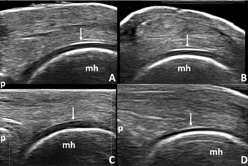 <p>Anechoic (black) layer overlying the periosteum</p>