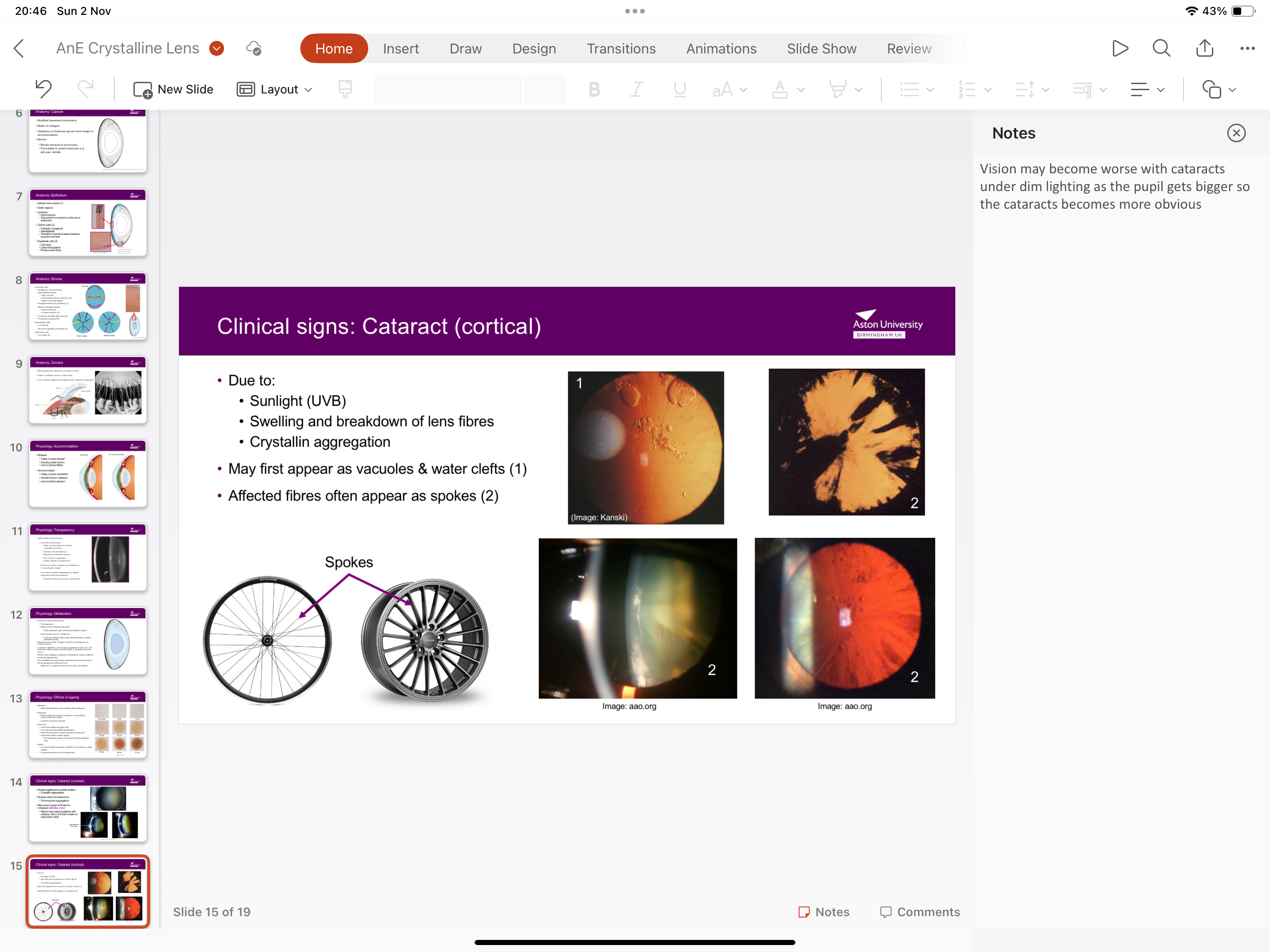 <p>May first appear as vacuoles and water clefts, excited fibres often appear and stokes.</p><p>Vision becomes worse under dim lighting as pupil diabetes so cataract becomes more obvious</p>