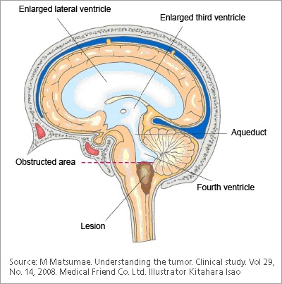 <p>Obstructive Hydrocephalus</p>