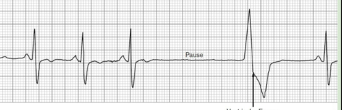 <p>Sinus rhythm → long pause → singular ventricular beat → return to normal rhythm</p>