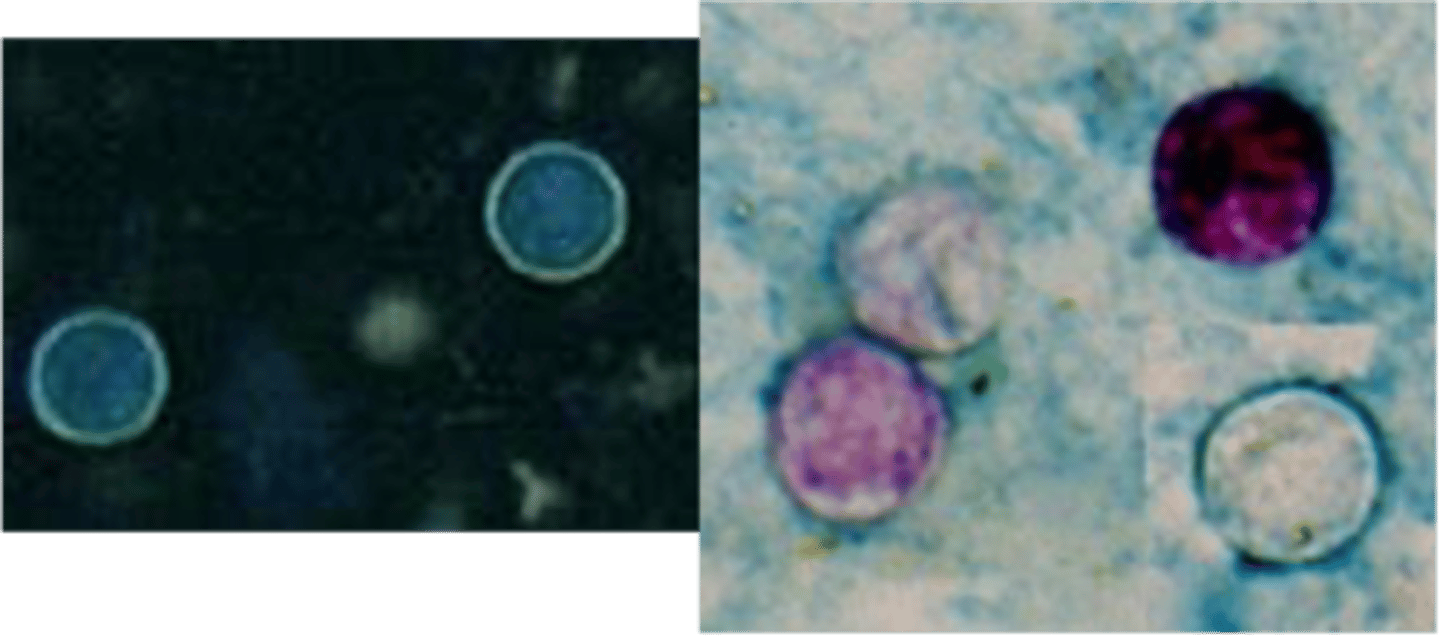 <p>Identify Pathogen causing Diarrhea:</p><p>-Hx:</p><p>&gt; Fecal-Oral Transmission (cysts in stool --&gt; contaminate water)</p><p>&gt; Contaminated fresh food products</p><p>&gt;&gt; Soft Fruits (raspberries, blackberries, and strawberries)</p><p>&gt;&gt; Leafy veggies (lettuce &amp; mixed salad)</p><p>&gt;&gt; Herbs (basil &amp; cilantro)</p><p>-Path: Freshly passed in stools, unsporulated oocyst is not infective --&gt; ​Oocysts excyst in the GI tract, freeing the sporozoites which invade the epithelial cells of the SI --&gt; Inside cells, they undergo asexual multiplication and sexual development to mature into oocysts, which will be shed in stools ​</p><p>-Sx/PE:</p><p>&gt; Watery Diarrhea</p><p>-Dx:</p><p>&gt; Stool: Modified acid-fast stain of oocysts or modified ("hot") safranin techniques</p><p>&gt; UV Microscopy = Blue/Green Oocysts</p><p>&gt; PCR of Stool</p>