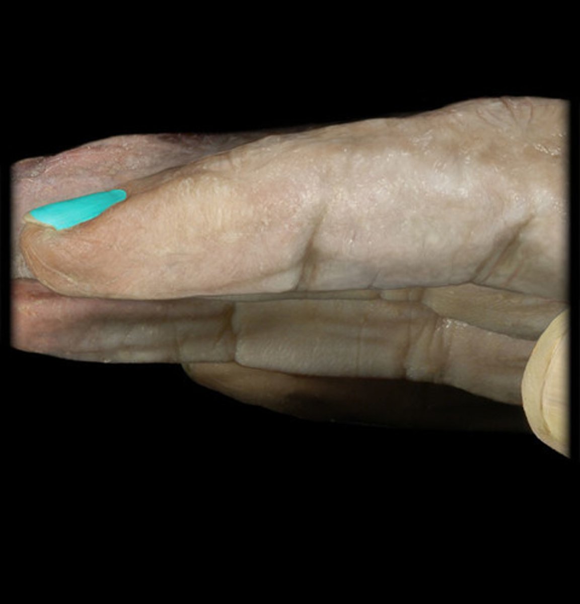 <p>- Visible part of the nail, composed of hard keratin.</p><p>- Found on the surface, extending from the nail root to the free edge.</p>