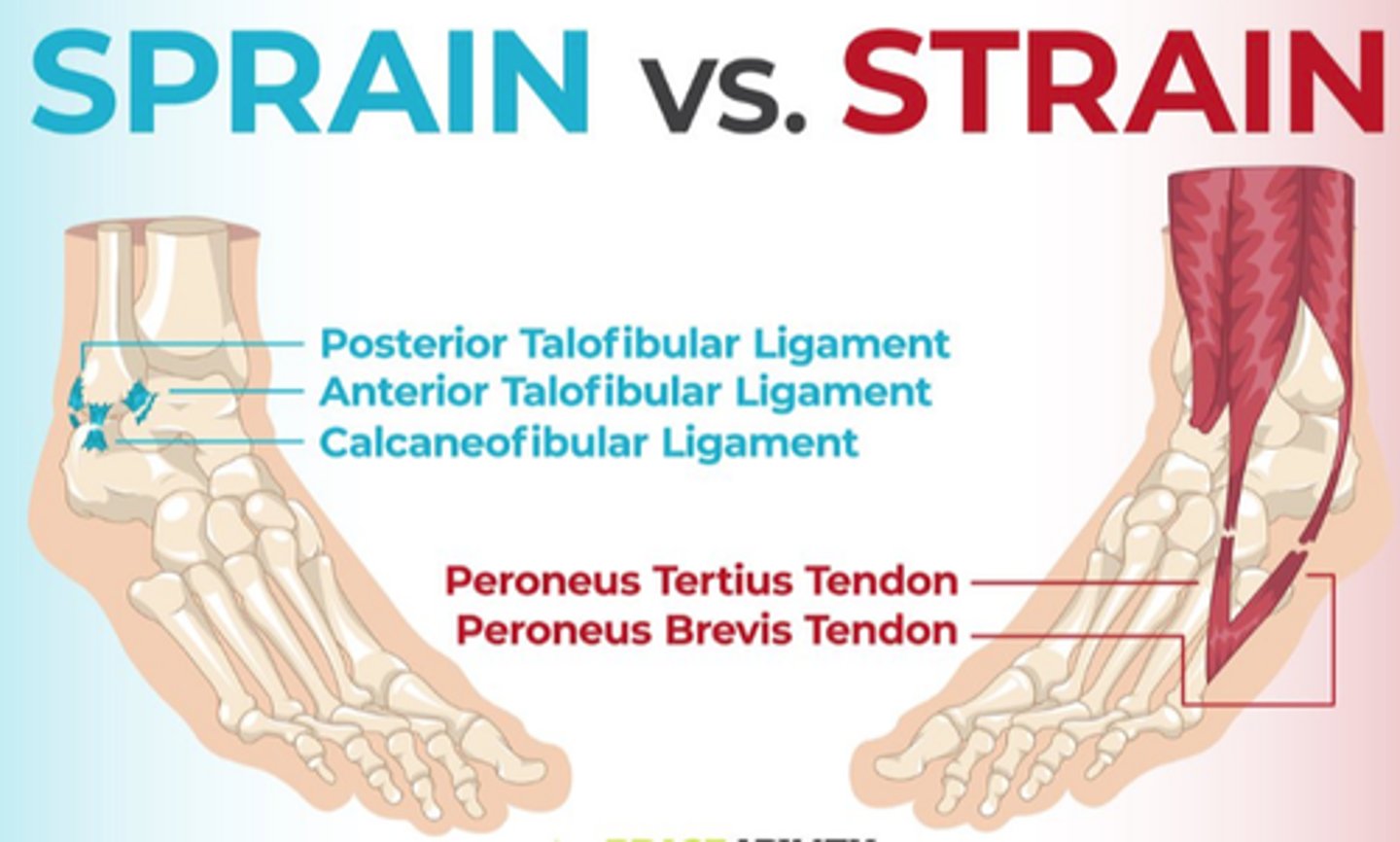 <p>Sprain: overstretching/damaging ligaments</p><p>STrain: T for TENDON, overstretching/damaging tendon.</p>