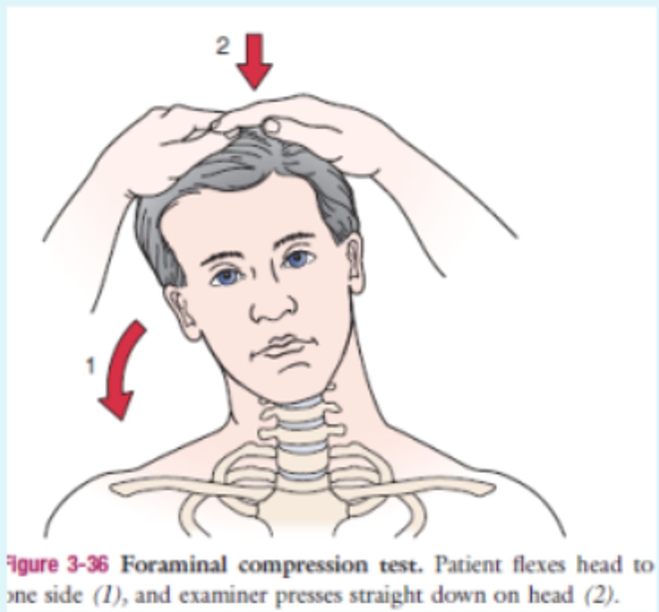 <p>- compression of cervical nerve root</p><p>(+): dermatome distribution pain and altered sensation</p>