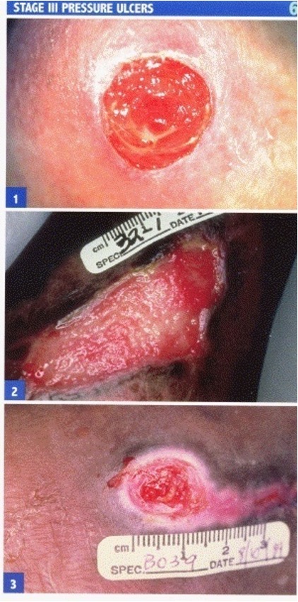 <ul><li><p>full thickness skin loss does not extend through fascia</p></li><li><p>doesnt involve muscle or bone</p></li><li><p>necrosis of SC tissue</p></li></ul><p></p>