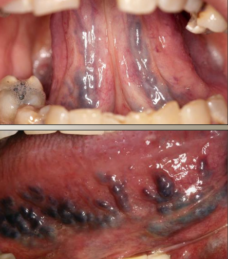 <p>What is the most common sublingual varix?</p>