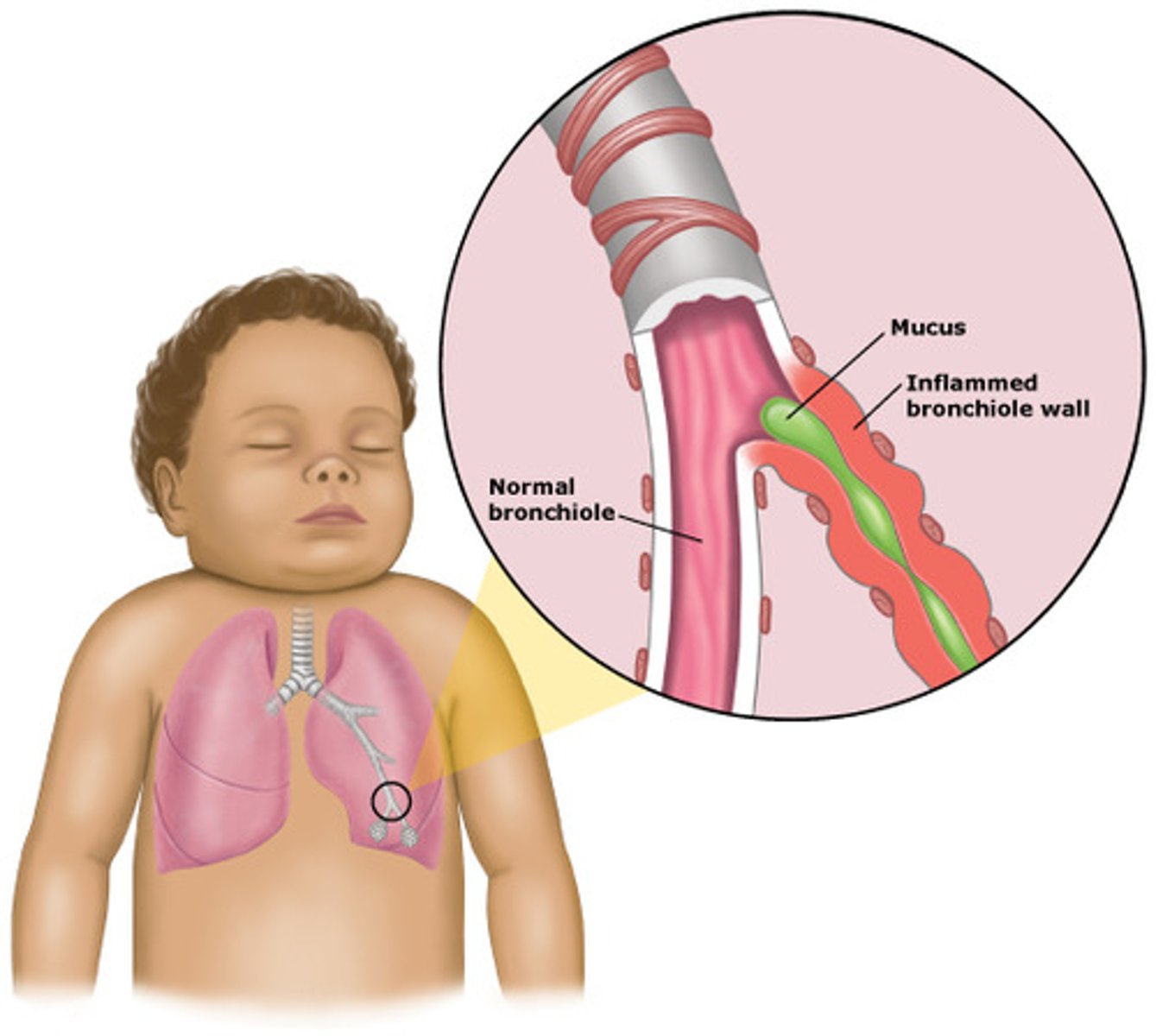 <p>- very young infants</p><p>- self-resolves</p><p>- Sudden onset</p><p>- Low grade fever</p><p>- Wheezing</p><p>- Coryza, Nasal congestion</p><p>- Prolonged respiration</p>