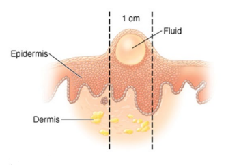 <p>What type of skin lesion is this?</p>
