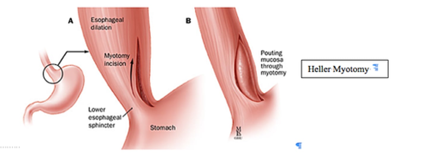 <p>is a surgical incision (the surgical cut made in the skin to access tissues) into a muscle.</p>