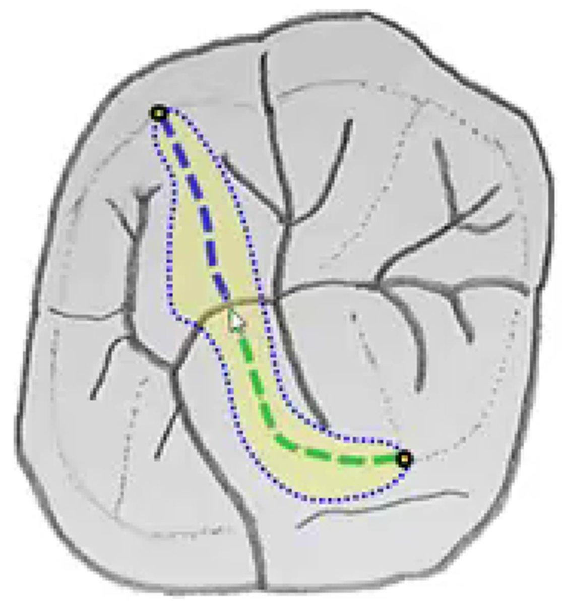 <p>- include distal pit and affected portion of groove</p><p>- cavosurface parallel</p>