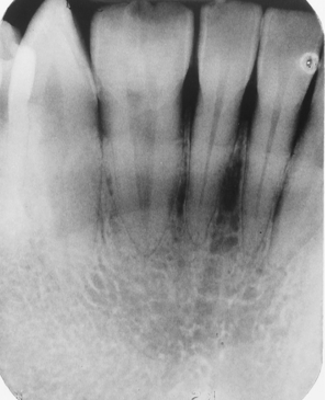 <p>In this image you can see the two central incisors and a single lateral incisor. Clinically, there was a notch in the midincisal area. The anomaly here is </p><p> </p><p>gemination</p><p> </p><p>fusion</p><p> </p><p>twinning</p><p> </p><p>microdontia</p>