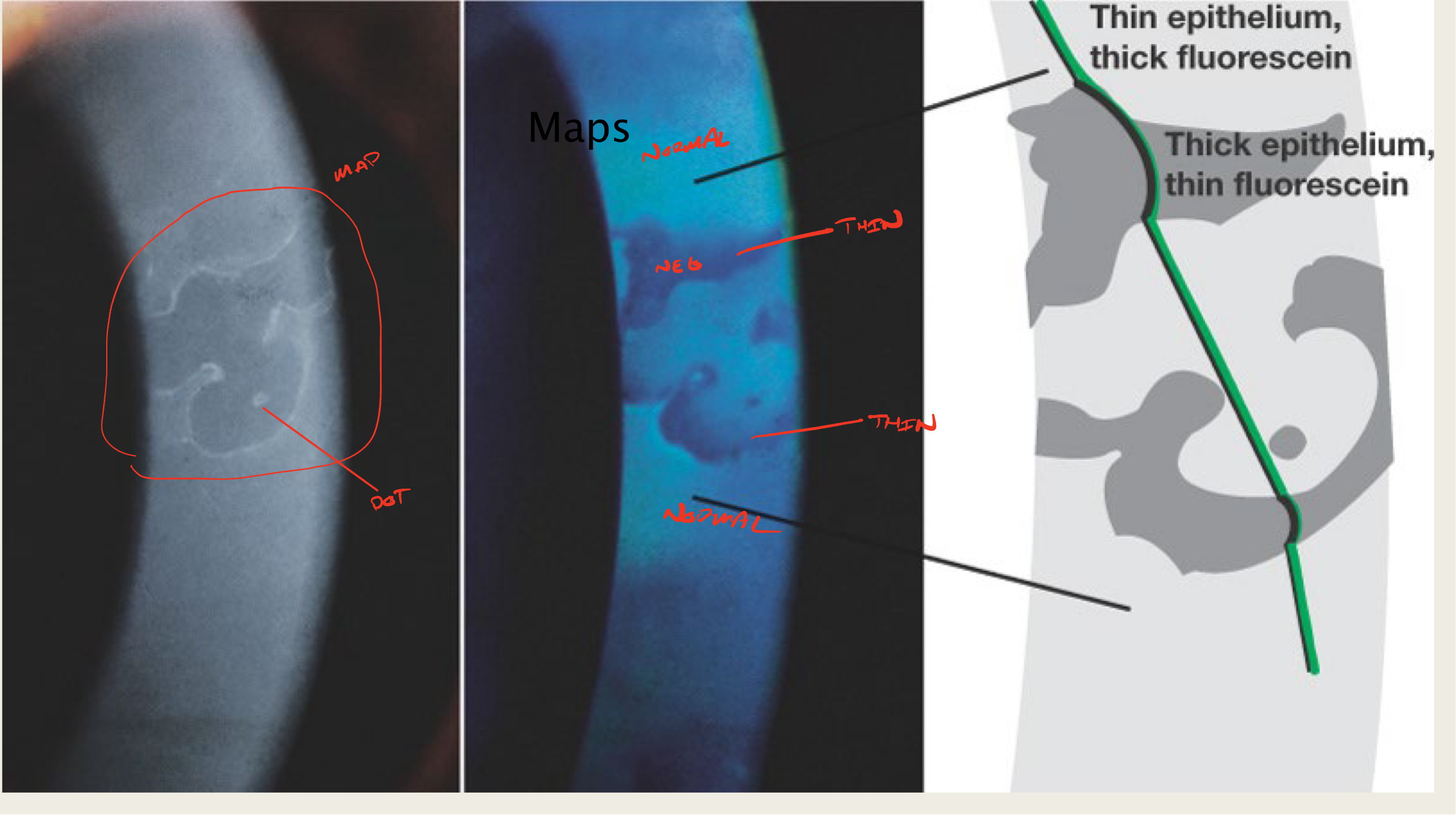 <p>large geographic lesion</p>