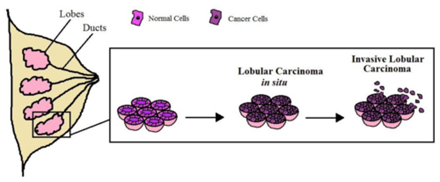 <p>It is the second most common breast cancer, difficult to detect on mammograms, and is generally ER+ and HER2-.</p>