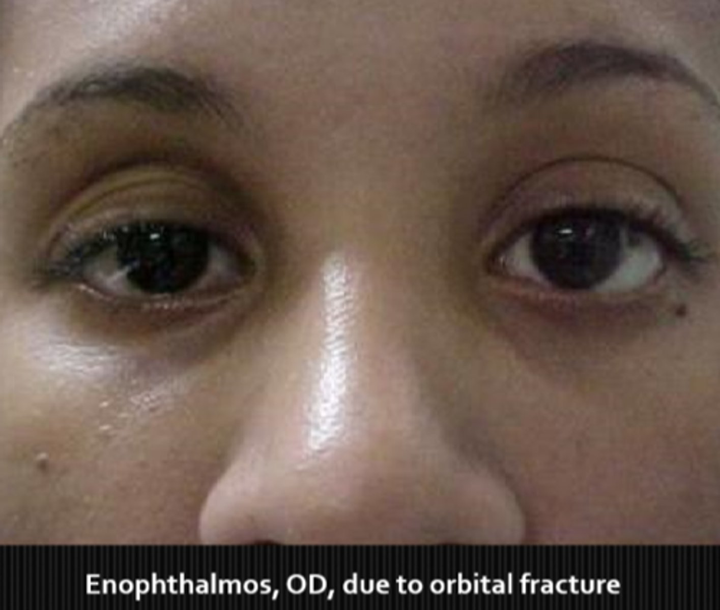 <p>orbital fractures </p><p>scirrhous carcinoma = dehiscence of orbital tissue</p><p>Duane's retraction syndrome = retracts globe as eye adducts</p>