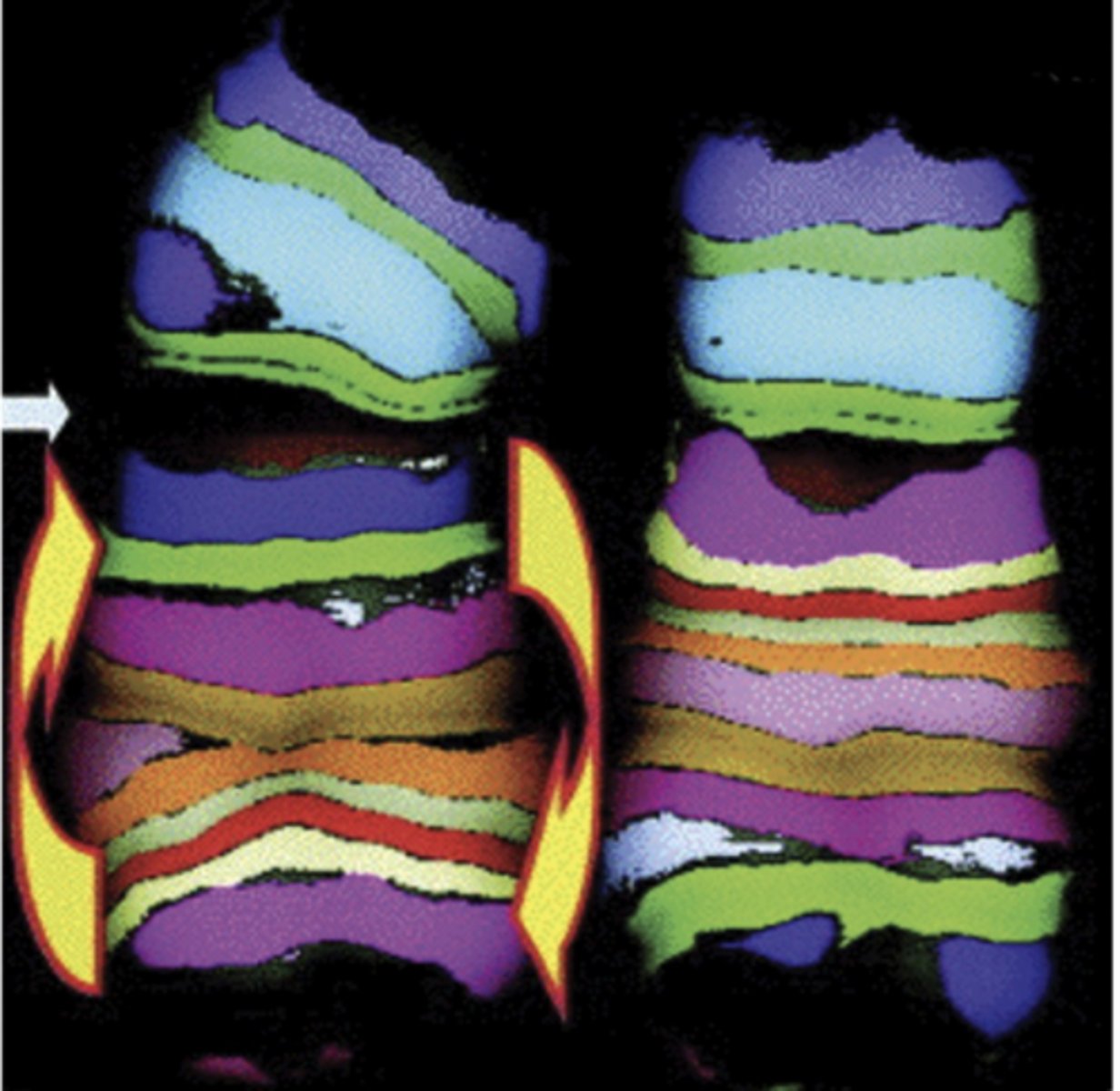 <p>FISH labeled intrachromosomal subregions reveals chromosome 5 inversion in a plutonium worker's cells</p><p>- power of FISH in determining aneuploidy</p>