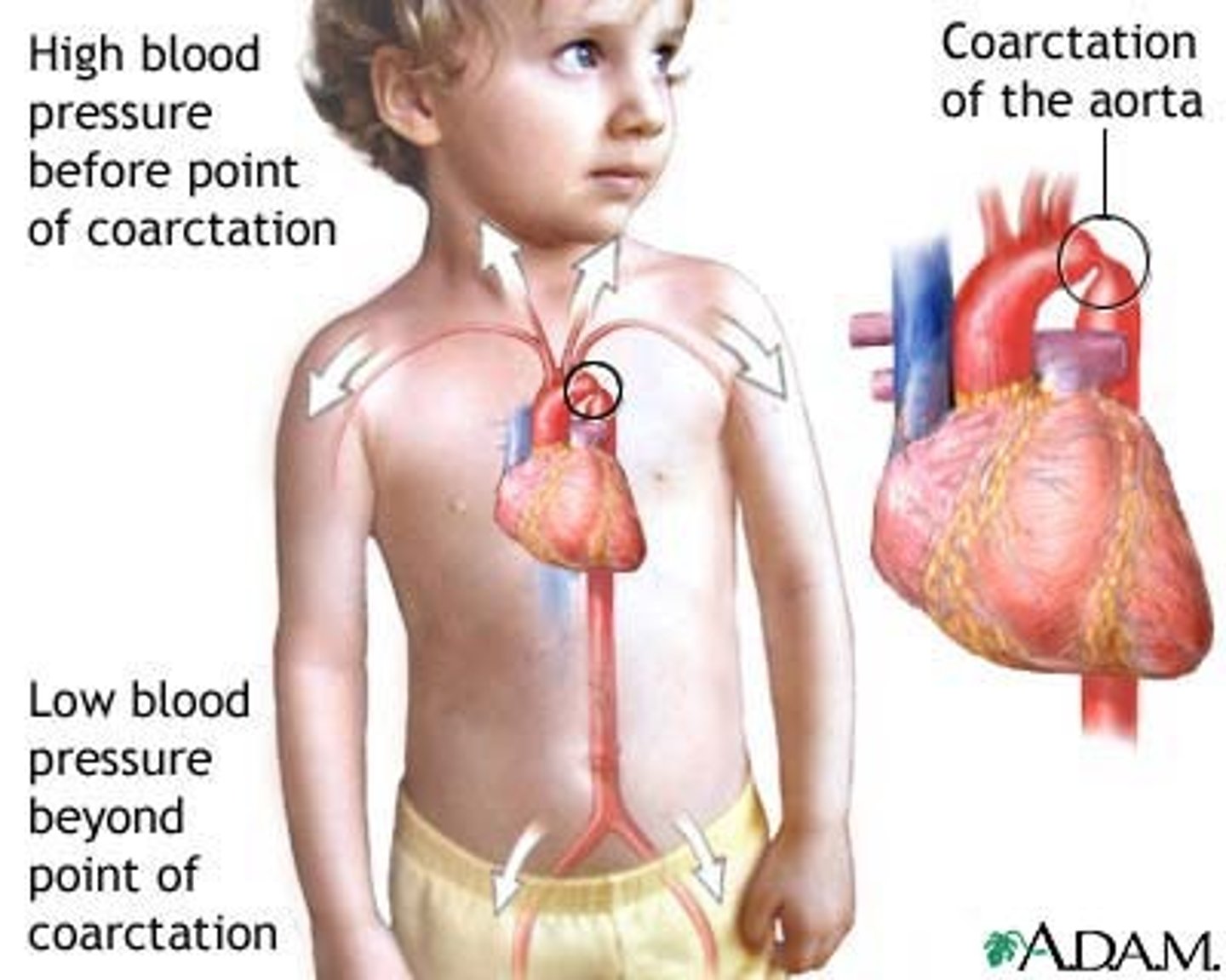 <p>a congenital, non cyanotic heart defect with narrowing of the aortic arch, just below the origin of the left subclavian artery and typically at, or just proximal to the ductus arteriosus</p>