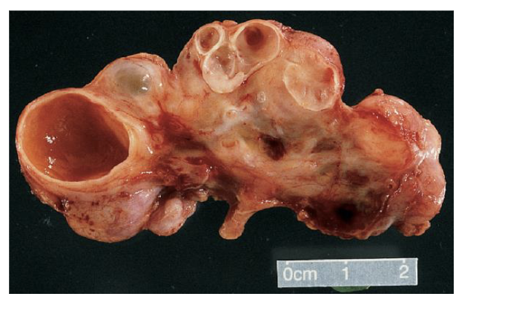 <ul><li><p>AKA Multicystic dysplastic kidney (MCDK)</p></li><li><p>malformation during fetal development resulting in disorganized architecture of the cortex and medulla</p></li><li><p>usually only 1 kidney, often with minimal clinical impact</p></li><li><p>degree of abnormality (cysts) will determine kidney function</p></li><li><p>multiple cysts often cause urinary tract obstruction </p></li></ul><p></p>