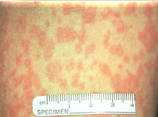 <p>often due to <strong>DRUG REACTIONS</strong>, infections, or autoimmune conditions symptoms such as fever, <strong>RASH</strong>, and eosinophilia. </p>