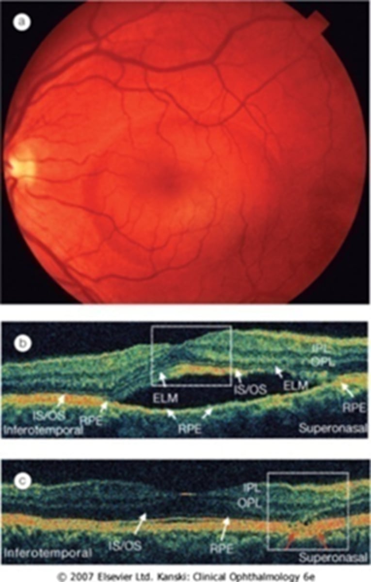 <p>localized serous detachment of sensory retina from RPE at the macula or posterior pole</p><p>NOT rhegmatogenous = no break in retina</p>