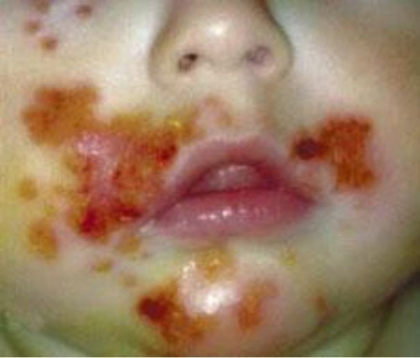 <p>1. nonbullous- MC - characteristics "honey colored crust" - vesicles and pustules - MC cause is s. aureus, 2nd MC GABHS (strep. pyogenes)</p><p>2. bullous- vesciles turn into bullae then rupture into thin crusts - accompanying fever and diarrhea - s. aureus MC cause but rare and if seen will be in newborn/infants</p><p>3. ecthyma- ulcerative pyoderma caused by GABHS that will scar with healing - also rare</p>
