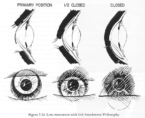 <p>What are the two main corneal GP philosophies?</p>